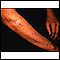 Lichen planus on the arm