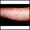 Erythema nodosum associated with sarcoidosis