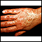 Vasculitis - urticarial on the hand