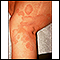 Ringworm - tinea corporis on the leg