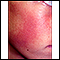 Keratosis pilaris rubra faceii