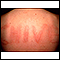 Dermatographism on the back