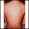 Drug rash on the back