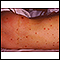 Meningococcal lesions on the back