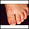 Hand, foot, and mouth disease on the foot