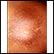 Post-inflammatory hyperpigmentation 2