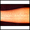 Dermatographism - arm