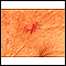 Basal Cell Carcinoma - close-up