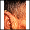 Actinic keratosis - ear