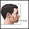 Chin augmentation - series