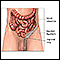 Inguinal hernia repair - series