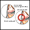 Lateral collateral ligament pain