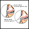 Torn lateral collateral ligament