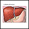 Cirrhosis of the liver