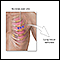 Incision for lung biopsy