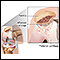 Chondromalacia of the patella