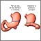 Gastrectomy