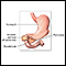 Annular pancreas