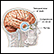 Brain herniation