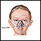 Nasal CPAP