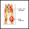 Sciatic nerve damage