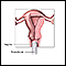 Transvaginal ultrasound